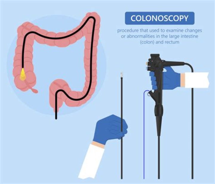 Are there free colonoscopies?