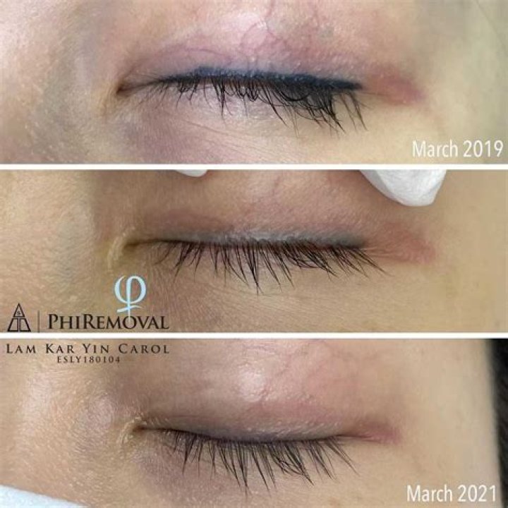 Can you get eyeliner tattoo removed?
