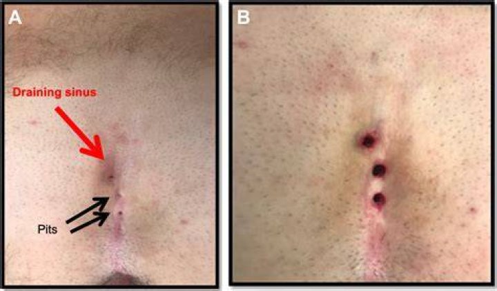Does pilonidal cyst surgery leave a scar?