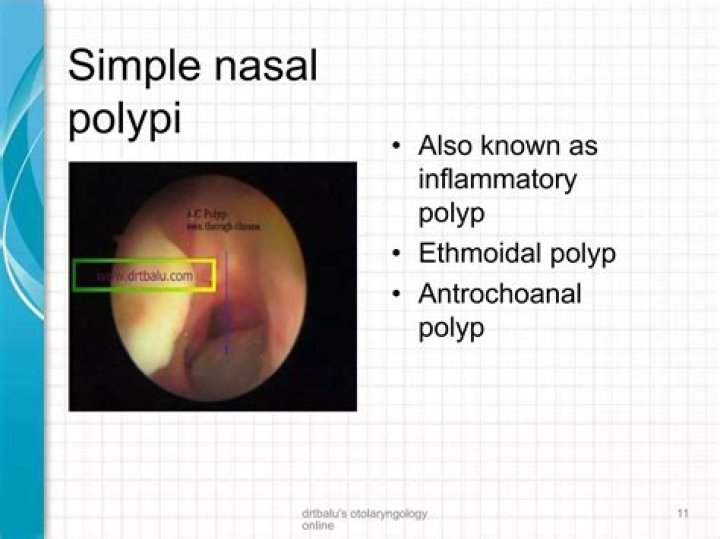 How are Antrochoanal polyps diagnosed?