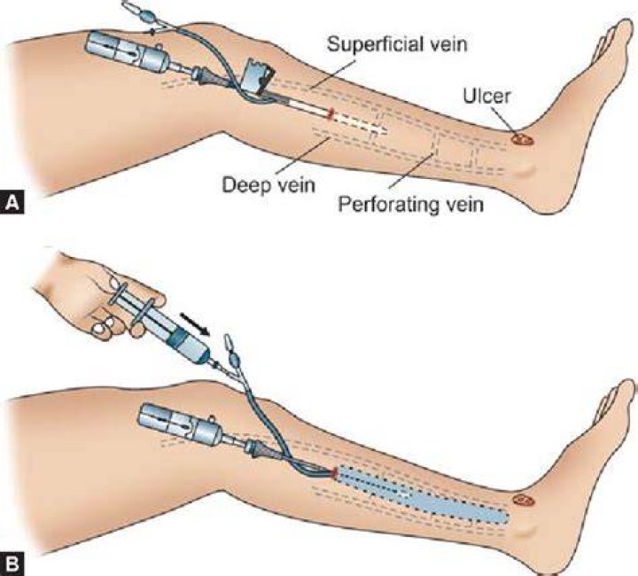 How do you treat an incompetent perforator?