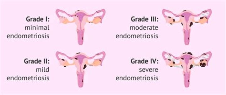 How many grades of endometriosis are there?