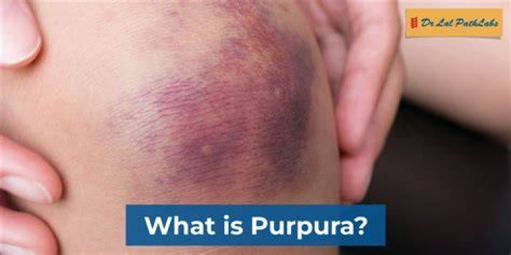 Is a purple spot bad?