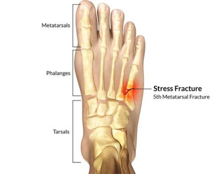 Is my metatarsal broken or sprained?