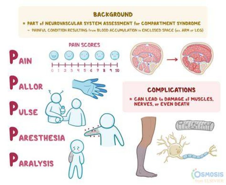 What are the 5 signs of compartment syndrome?