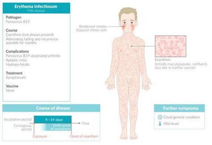 What are the symptoms of parvovirus B19?