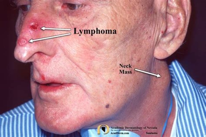 What do lymphoma skin lesions look like?