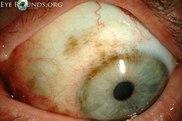 What does Brown spots on sclera mean?