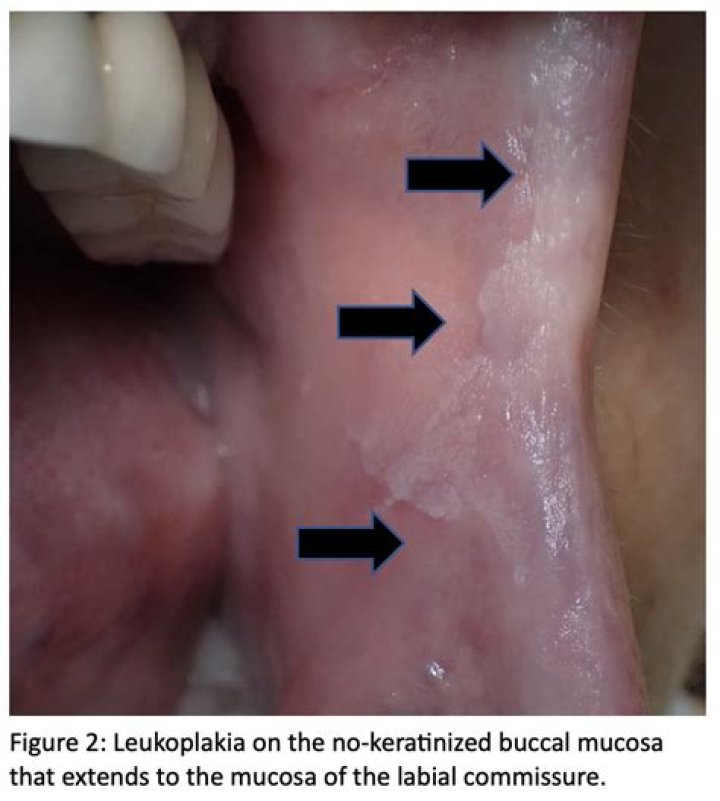 What does leukoplakia look like in the throat?