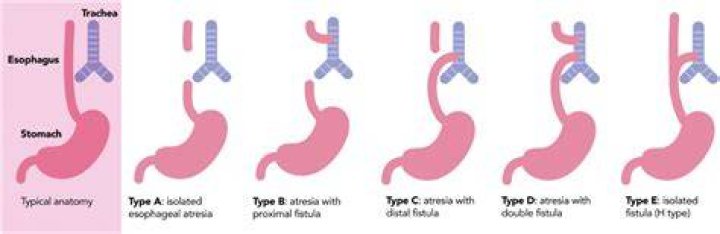 What is esophageal atresia (EA)?