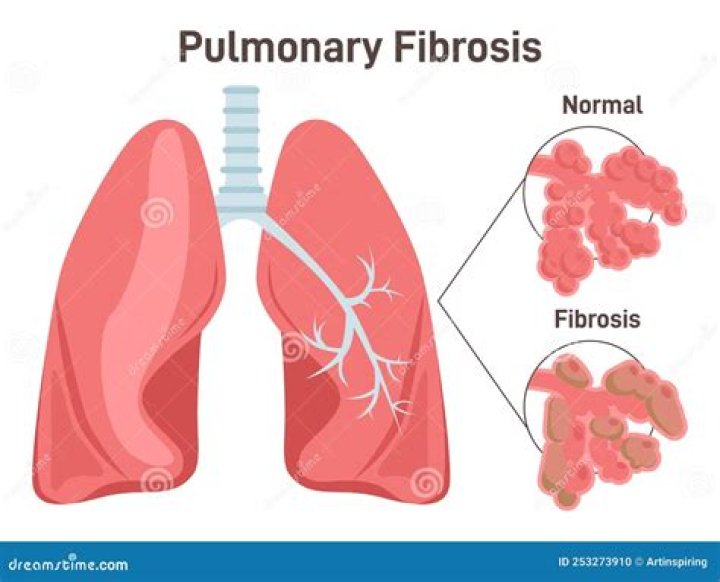 What is fibrotic nodule?