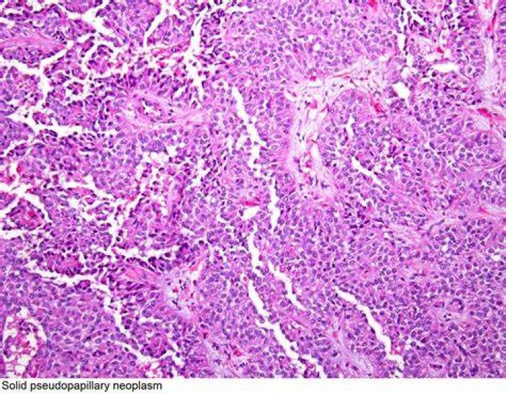 What is pseudopapillary neoplasm?