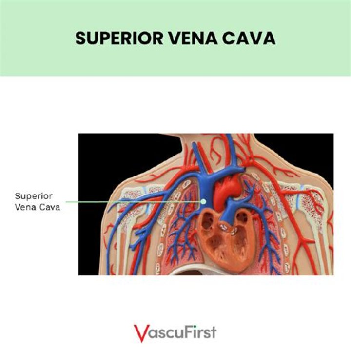 What is vena cava interruption?