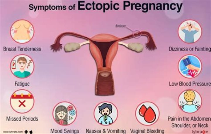 What should be avoided after ectopic pregnancy?