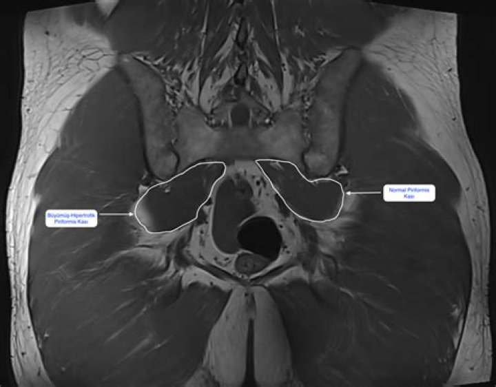 Will piriformis syndrome show on MRI?